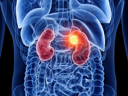 Câncer Renal