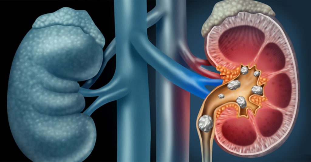 Ilustração de cálculo renal